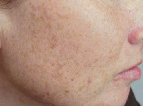 skin problems with dark spots